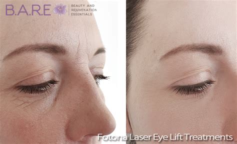 SmoothEye Non-Surgical Laser Eye Lift - B.A.R.E. Essentials Spa