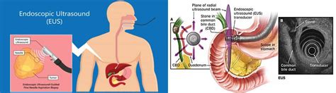 Дурангийн хэт авиан шинжилгээ - Endoscopic ultrasound /EUS/ - Intermed ...