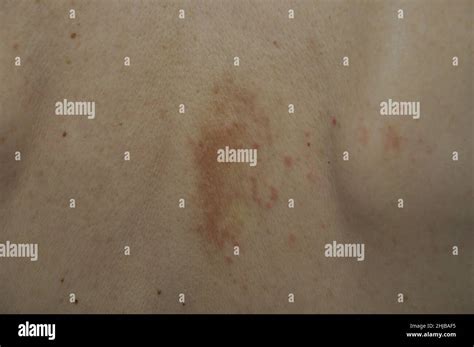 Eczema pimples on a back Stock Photo - Alamy