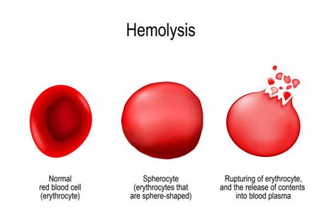 220+ Hemolysis Stock Photos, Pictures & Royalty-Free Images - iStock