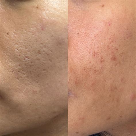 Before&after TCA cross #1 : r/AcneScars