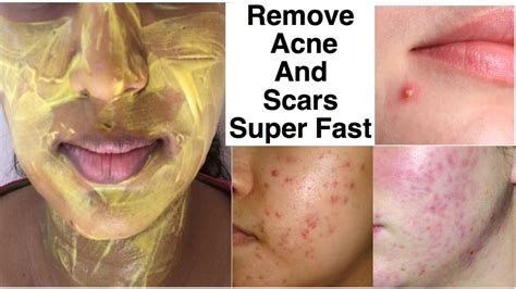 5 Home Remedies For Acne Scars For Your Skin