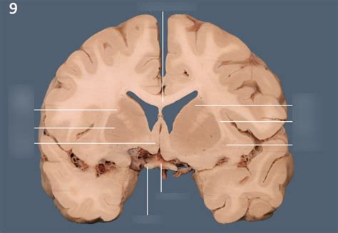 coronal brain section  diagram quizlet