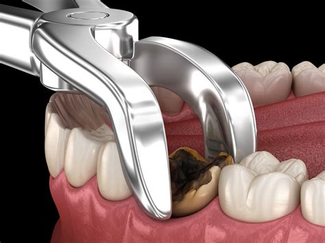 Extraction - Heatherton Dental