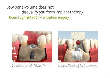 Wotton Dental & Implant Clinic - What is bone augmentation?