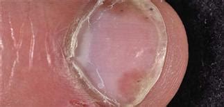 Psoriasis: nails | Clinical Gate