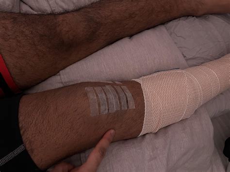 Possible lateral meniscus injury 6 days after medial meniscus repair