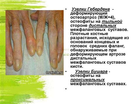Алгоритм диагностики суставного синдрома. Основные заболевания ...