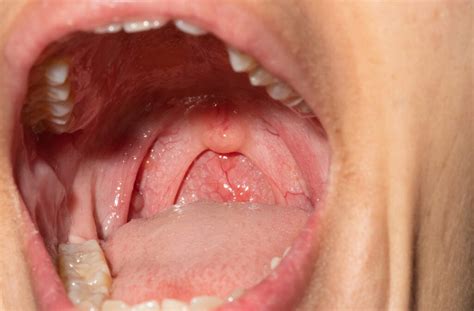 Cobblestone Throat: Symptoms, Pictures & Treatment