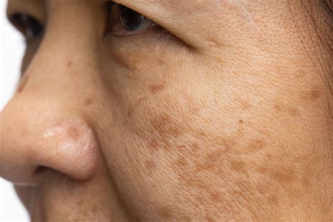 Tranexamic acid for melasma