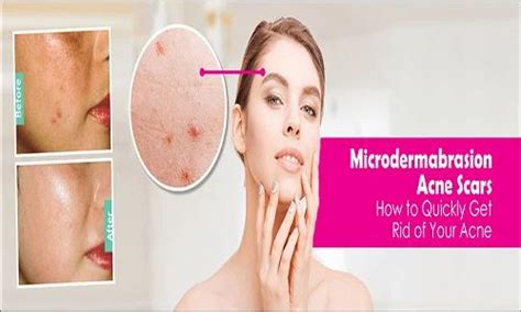 Microdermabrasion Treatment at Rs 499/unit in Noida | ID: 19126411112