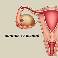 Лечение кисты яичника медикаментозно: свечи, противозачаточные и ...