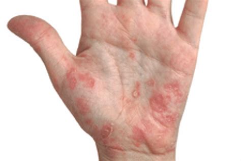 Fungal Skin Infection Hands