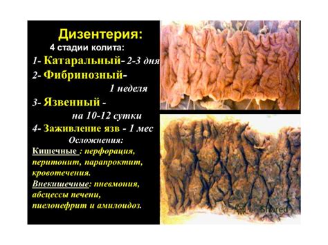 Кишечная-инфекция