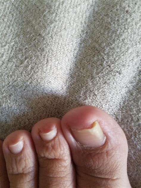 Half Toenail Is White at Ruby Hereford blog