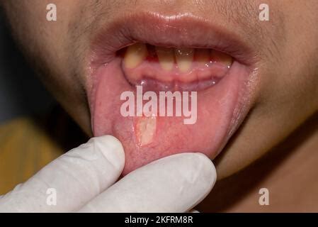 aphthous ulcer  stress ulcer  mouth  asian child stock photo alamy