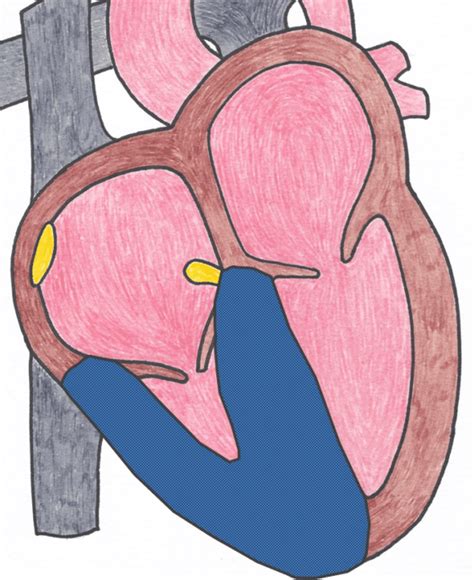 Identifying Right Ventricular Hypertrophy On An ECG