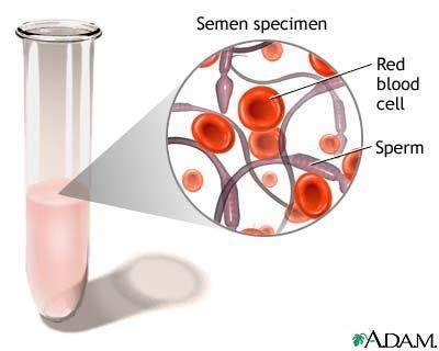Hematospermia after a vasectomy? – Northeast Georgia Urological Associates