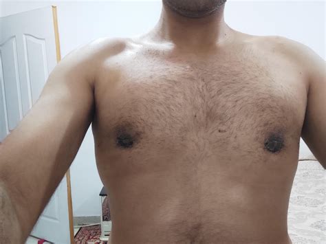 My Gynecomastia nightmare stories (PO Pics included) : r/gynecomastia