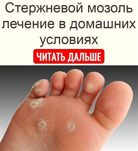 Стержневая мозоль на ногах, пальце, ступне: удаление и лечение