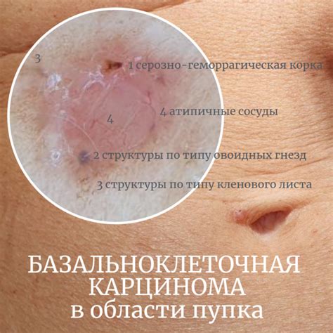 БАЗАЛЬНОКЛЕТОЧНАЯ КАРЦИНОМА околопупочной области — nevus.pro