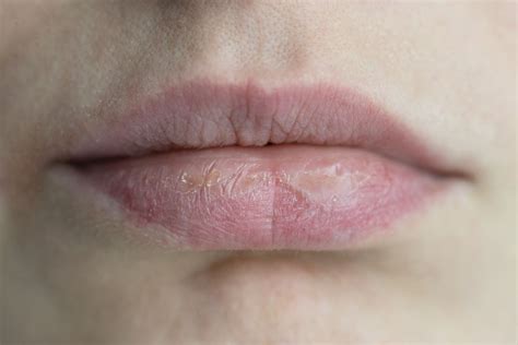Can Cold Sores Cause Dry Lips | Lipstutorial.org