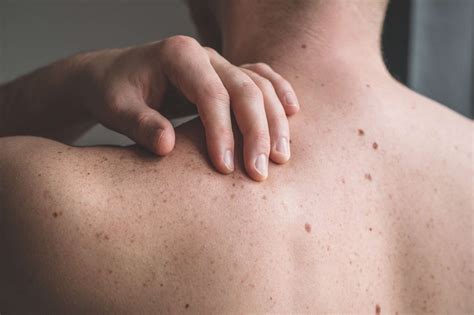 Skin Lesions: Pictures, Types, Causes, Treatment