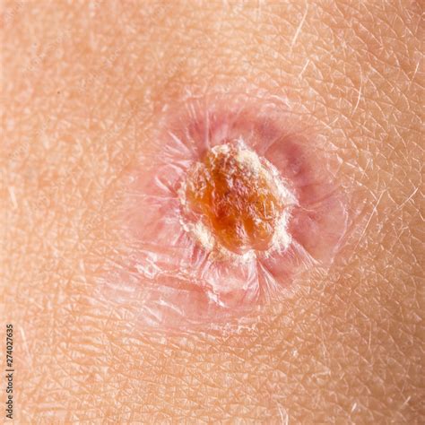 minor wound infection