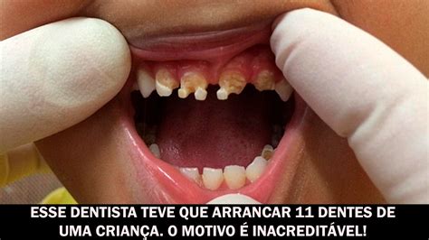 Crianca Que Nao Escova Dente - Esse dentista teve que arrancar 11 dentes de uma criança. O motivo é ...