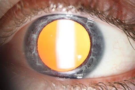 ocular albinism centre  eye health
