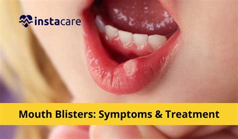 Mouth Blisters - Symptoms, Treatment, And Prevention Methods