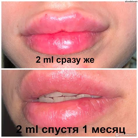 Контурная пластика препаратом Stylage - «3 ML за 3 месяца в губы! Я ...
