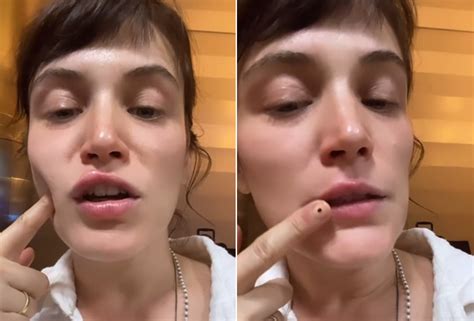 Grandes Lábios Inchados E Coçando - Bianca Bin mostra lábios inchados após reação alérgica: 'Está coçando e ...