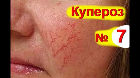 Купероз на лице ! Народные средства от купероза - розацеа лечение - № 7 ...