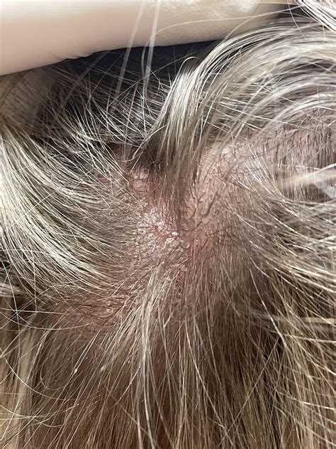 Seb derm or something else? : r/SebDerm