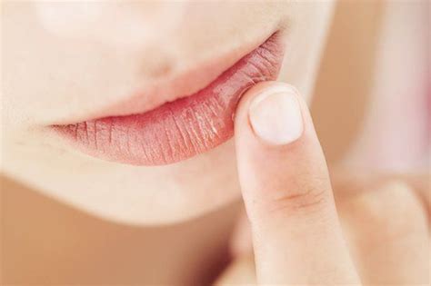 kenali penyebab bibir kering pucat  pecah pecah