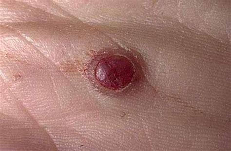 PYOGENIC GRANULOMA - Stamford Skin Centre