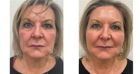 Thread Lift Before And After Uk An Instant Facelift T - vrogue.co