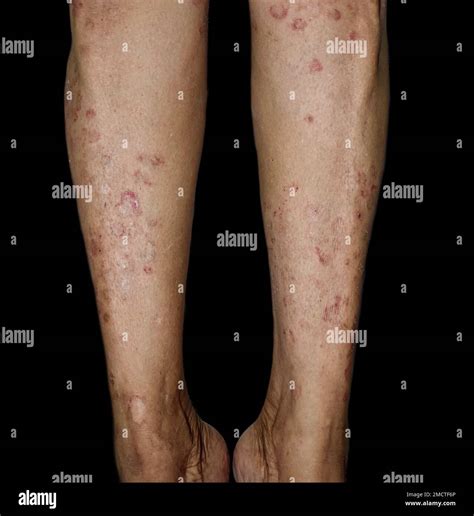 Fungal infection called tinea corporis in leg of Asian woman ...