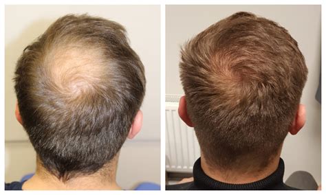 crown hair transplant timeline    expect