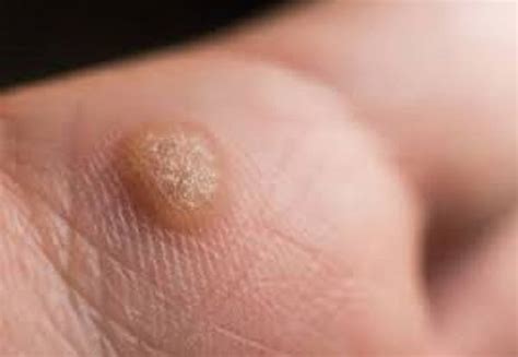 common warts symptoms