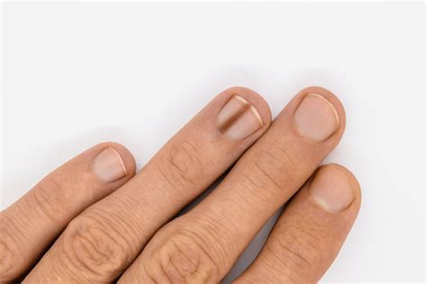 What is Nail Melanoma? Signs and Symptoms to Watch For