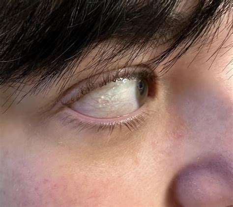 weird bumpy  rsarcoidosis