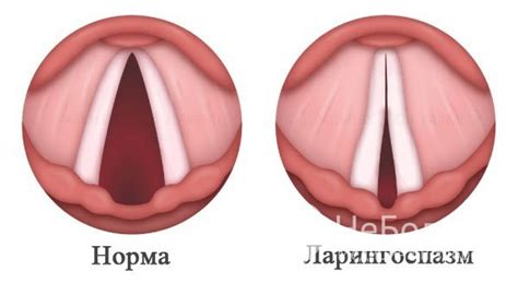 Ларингоспазм у детей и взрослых – симптомы, лечение, помощь, причины
