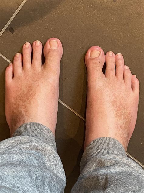 Orange Skin Feet at Victoria Mcbrien blog