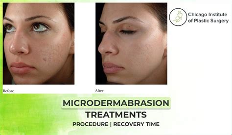 Microdermabrasion Treatments: Procedure | Cost | Recovery Time| Uses ...