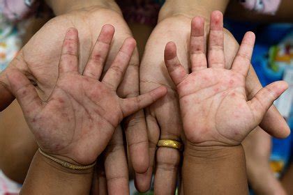 Hand Foot And Mouth Blisters On Hands Flash Sales | emergencydentistry.com