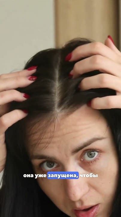 ПЕРХОТЬ Ч. 1/4 - как лечить перхоть, (себорейный дерматит на голове) # ...