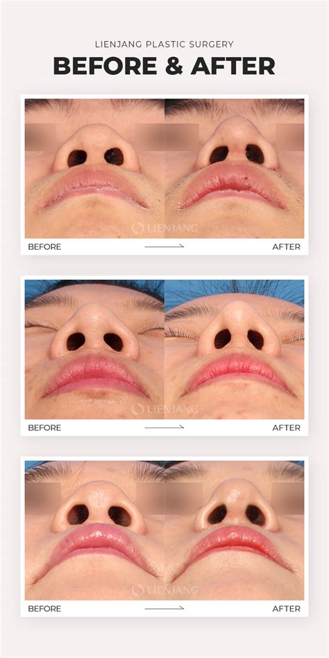 Alar Reduction - Lienjang Clinic Korea