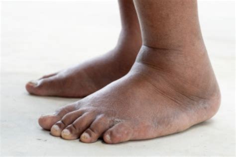 Peter Siroka DPM, P.C. - Causes of Swollen Feet